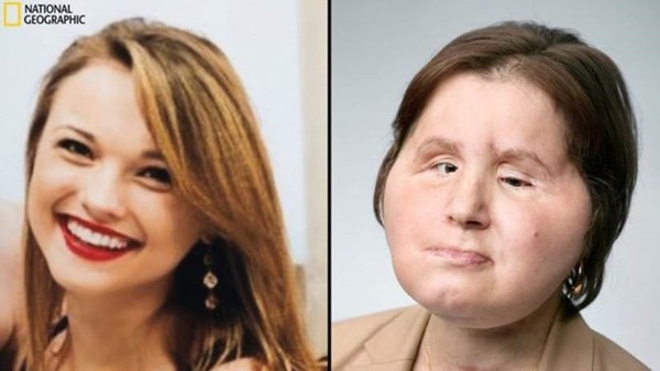 Antes e depois do transplante de rosto: paciente mais jovem da cirurgia experimental sonha ir para a faculdade
